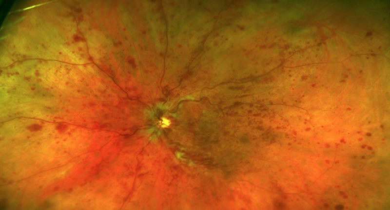 Diabetic Retinopathy Monitoring